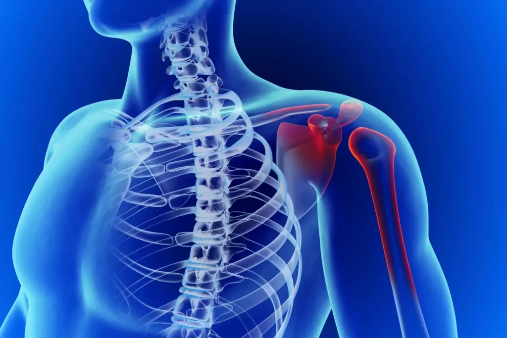Вывих плеча – как возникает и как лечить эту травму?